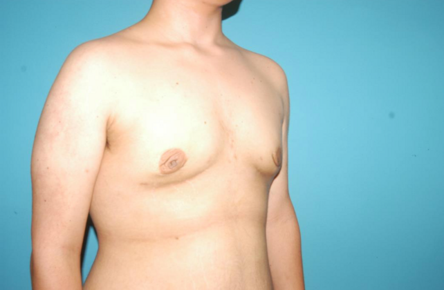 Gynecomastia: Case 8 - After