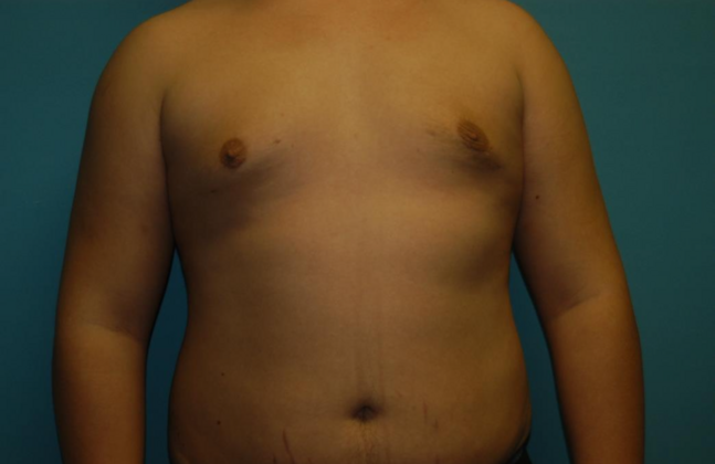 Gynecomastia Case 9 - After