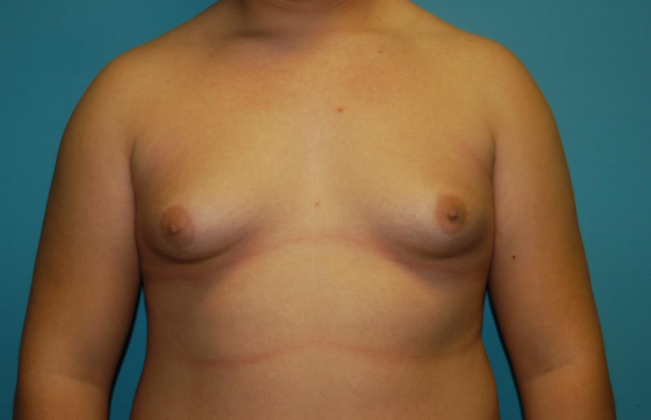 Gynecomastia Case 9 - Before