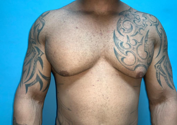 Gynecomastia Case 10 - Before