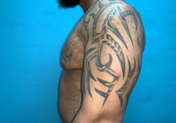 Gynecomastia: Case 10 - After