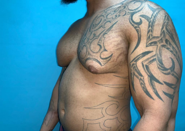 Gynecomastia: Case 10 - Before