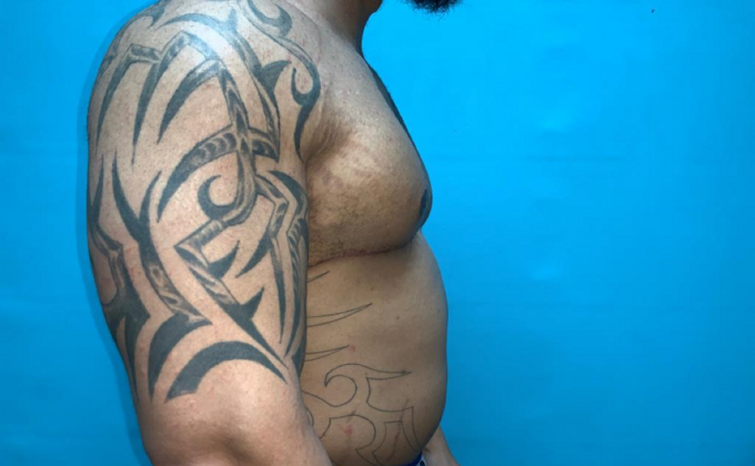 Gynecomastia: Case 10 - Before