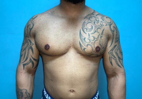 Gynecomastia Case 10 - After