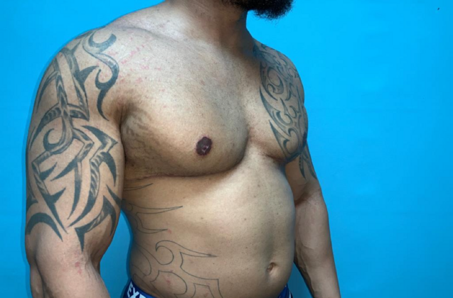 Gynecomastia: Case 10 - After