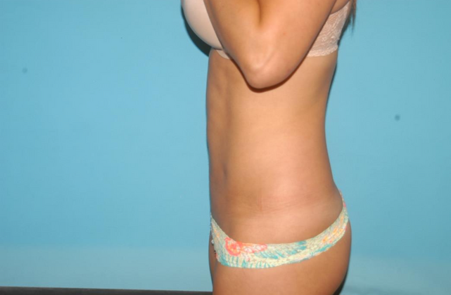 Liposuction: Case 1 - After