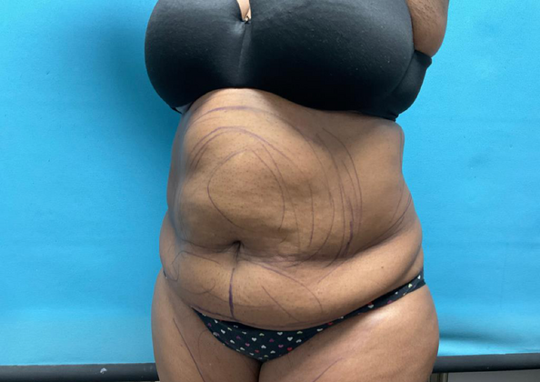 Liposuction: Case 2 - Before