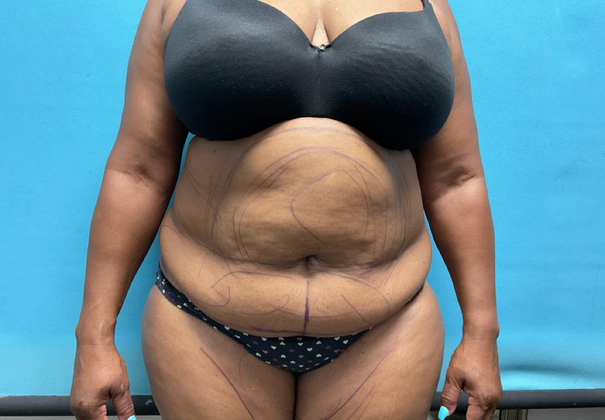 Liposuction Case 2 - Before