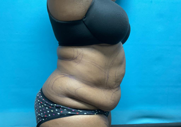 Liposuction: Case 2 - Before