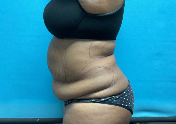 Liposuction: Case 2 - Before