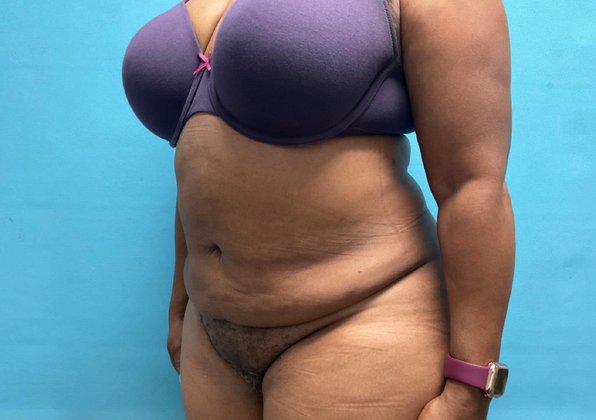 Liposuction: Case 2 - After