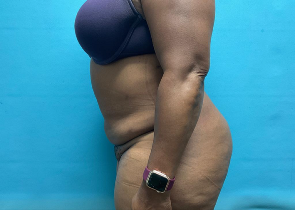 Liposuction: Case 2 - After