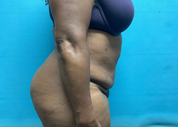 Liposuction: Case 2 - After