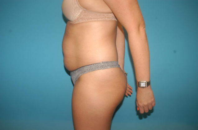 Liposuction: Case 3 - Before