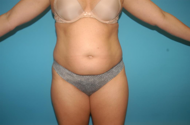 Liposuction Case 3 - Before