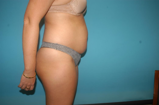 Liposuction: Case 3 - Before