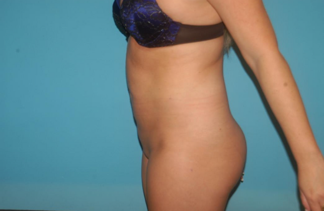 Liposuction: Case 3 - After