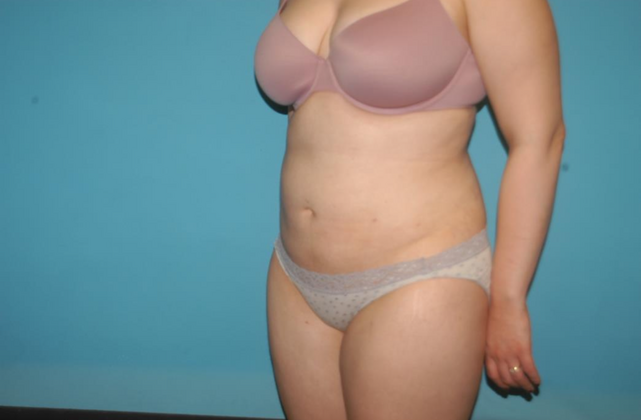 Liposuction: Case 4 - After