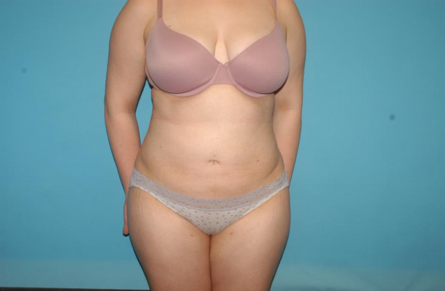 Liposuction Case 4 - After