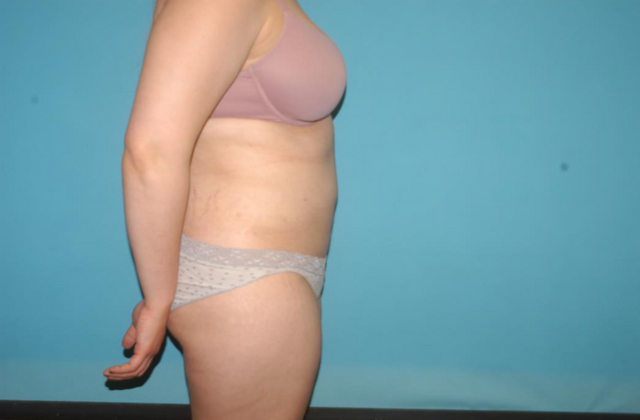 Liposuction: Case 4 - After
