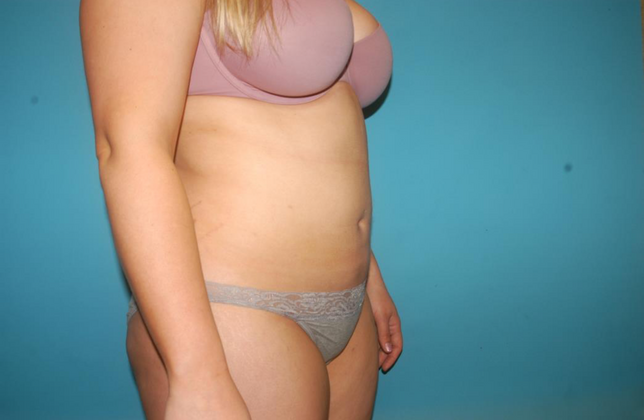 Liposuction: Case 4 - After