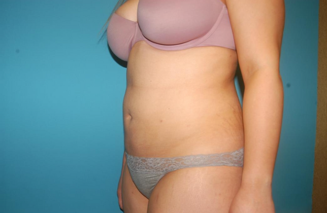 Liposuction: Case 4 - After