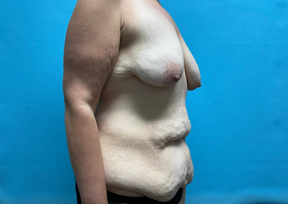 Mommy Makeover: Case 4 - Before