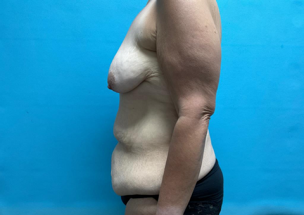 Mommy Makeover: Case 4 - Before