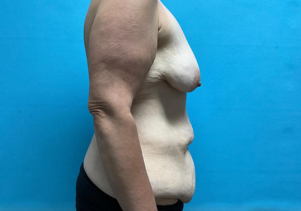 Mommy Makeover: Case 4 - Before