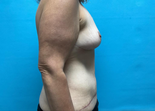 Mommy Makeover: Case 4 - After