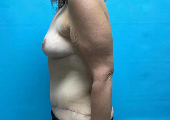 Mommy Makeover: Case 4 - After