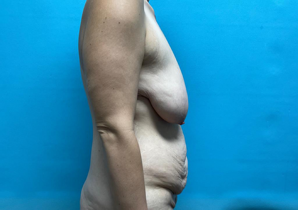 Mommy Makeover: Case 5 - Before