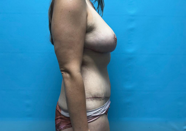 Mommy Makeover: Case 5 - After