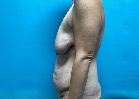 Mommy Makeover: Case 5 - Before