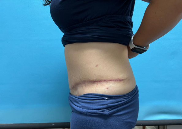 Mommy Makeover: Case 8 - After