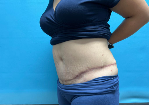 Mommy Makeover: Case 8 - After