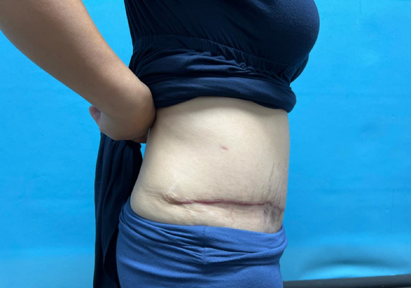 Mommy Makeover: Case 8 - After