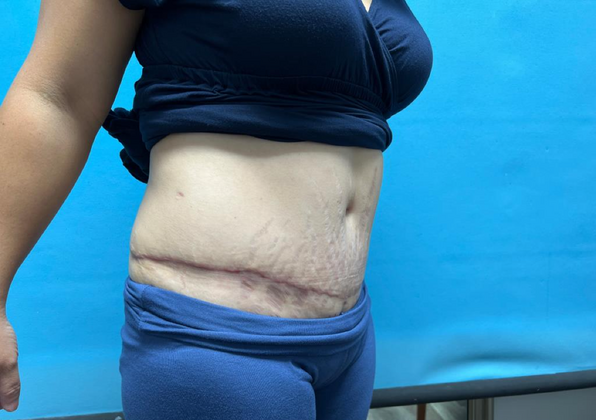 Mommy Makeover: Case 8 - After