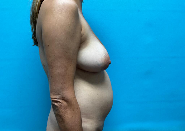 Mommy Makeover: Case 9 - Before