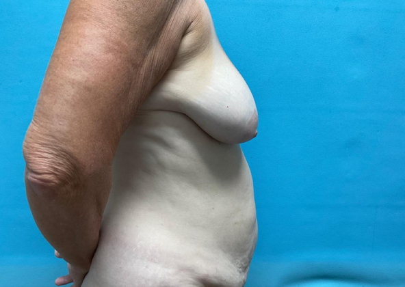 Mommy Makeover: Case 10 - Before