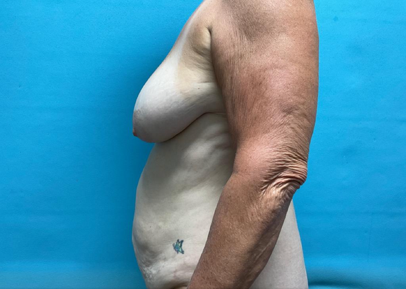 Mommy Makeover: Case 10 - Before