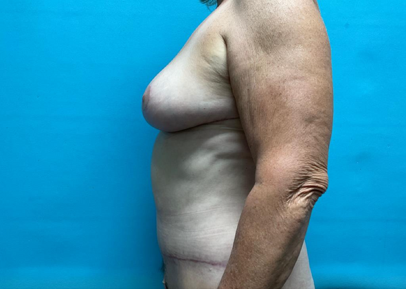 Mommy Makeover: Case 10 - After