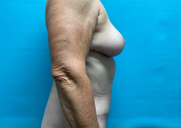 Mommy Makeover: Case 10 - After