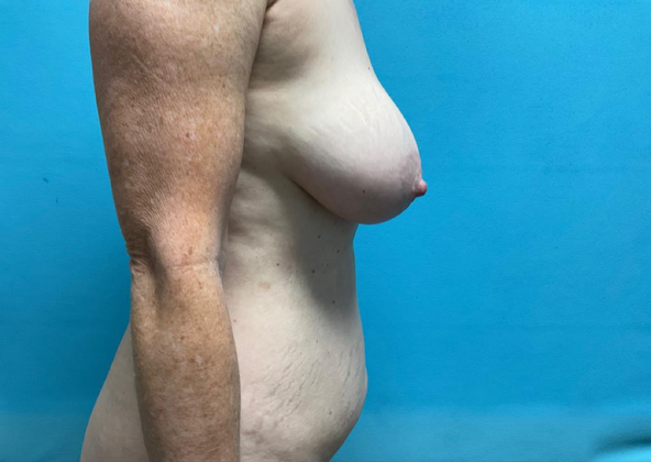 Mommy Makeover: Case 11 - Before