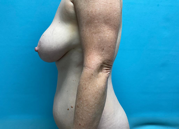 Mommy Makeover: Case 11 - Before