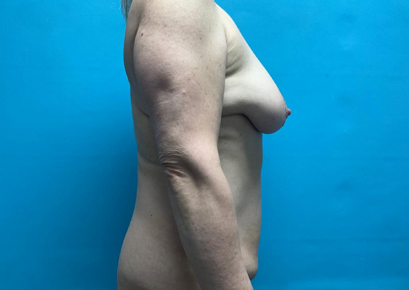 Mommy Makeover: Case 12 - Before