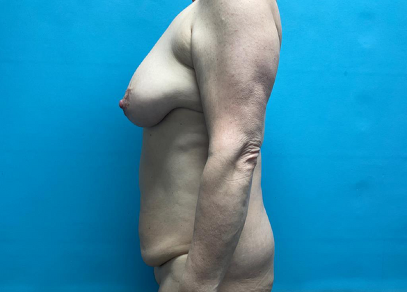 Mommy Makeover: Case 12 - Before