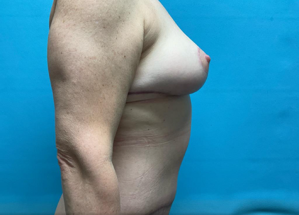 Mommy Makeover: Case 12 - After