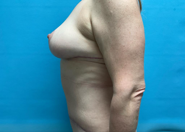 Mommy Makeover: Case 12 - After