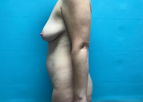 Mommy Makeover: Case 13 - Before